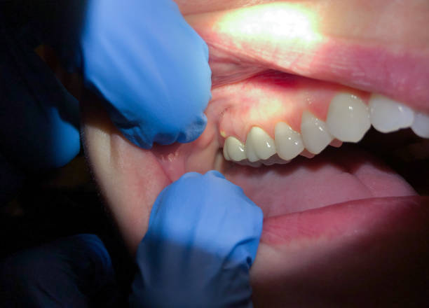 Best Urgent Care for Lost Fillings or Crowns in Salisbury, NC